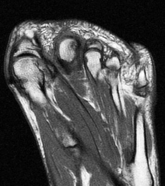 Figure 4 for case Plantar plate rupture